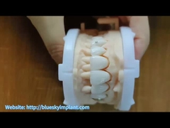 Coroa de zircônio com jóias