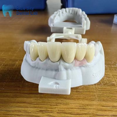 comprar Coroas de zircônio de camadas altamente translúcidas naturais com coroa de implante online manufacture