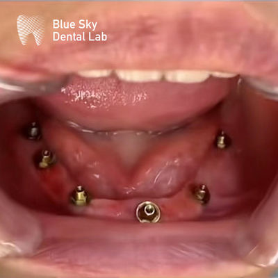 comprar Nature Design Implante Dental Caso Implante Operação Casos Para Múltiplas Opções online manufacture