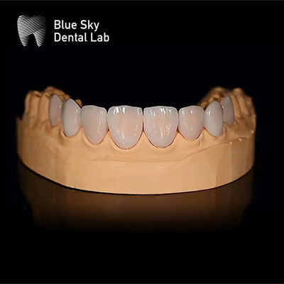 comprar Casos de revestimento dentário retangular leve com encaixe passivo Apenas 0,3 mm online manufacture