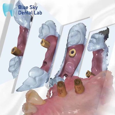 comprar Scan Body All In One Dental Healing Capsule Sistema de Implante Blue Sky online manufacture