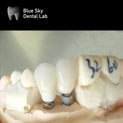 comprar Coroas únicas Abutment de zircônio Implante dental hipoalergênico Abutment de zircônio online manufacture
