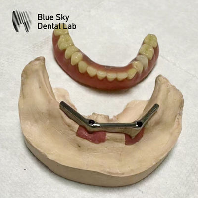 comprar Implante Dentário de barra de titânio Implante dentário com dentadura removível online manufacture