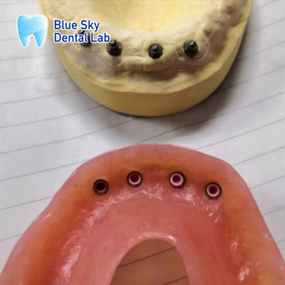 comprar Implante Removível Restauração Localizador Implante Dentária Restauração da Boca Completa online manufacture