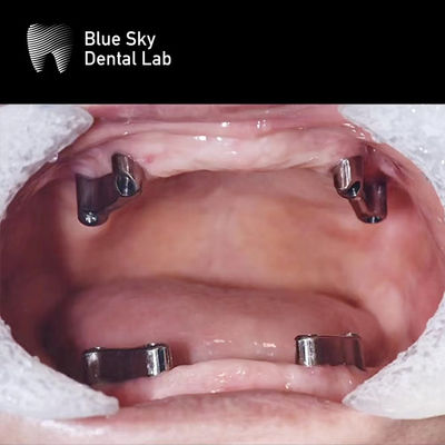 comprar Resina Dentes Dentários Titânio Bar Removível Blue Sky Implantação Sistema online manufacture