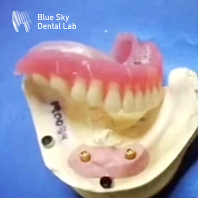 comprar Localizador dentário de titânio com dentadura removível e anexos de tampa de bola online manufacture