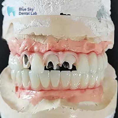 Ponte de titânio Malo Implante Ponte sem abutment de unidade múltipla Cementável