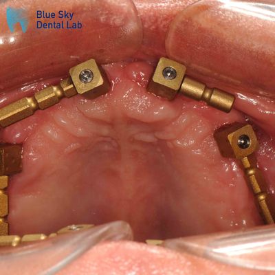 Ouro Titânio Multi Unit Scan Corpo CAM Sistema Dentium Scan Corpo