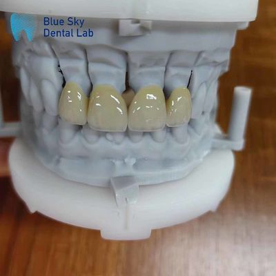Circónio durável revestido com porcelana Circónio coroa de várias camadas