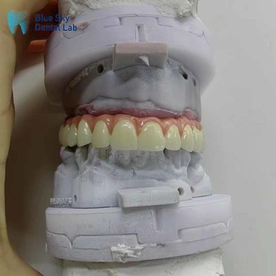 Nature Casas de implantes dentários artificiais Casas personalizadas de implantes bucais completos