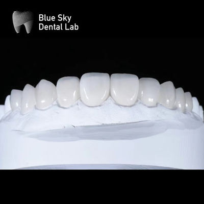 Casos de Veneer Premium Elegante Ultrafinos de 0,3 mm Veneers Emax