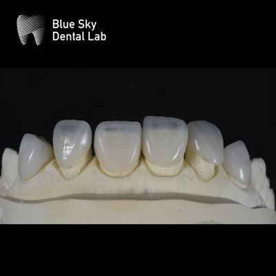 Casos de Veneers Ultrafinos e Elegante 0,3mm Veneers Personalizados Mais Finos