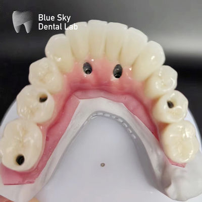 Casos de implantes dentários de arco completo compatíveis com sistemas de implantes múltiplos