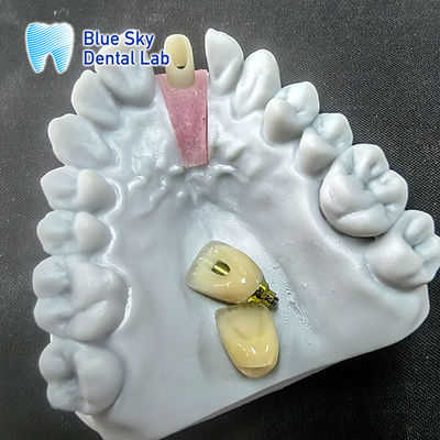 Abutment de zircônio moído de precisão com coroa de implante único