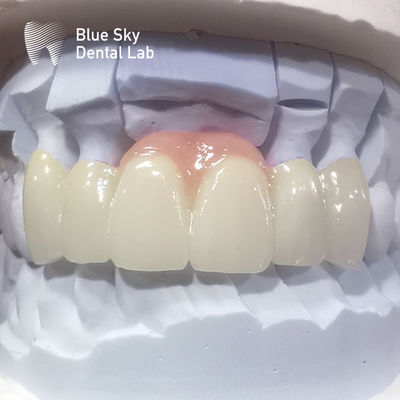 Coroas de zircônio em camadas de porcelana rosa Coroa dental de zircônio para restaurações estéticas