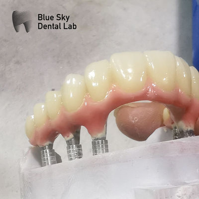 Natureza Forma de Implante de Arco Completo Casos de Implante Dental de Superfície Limpa
