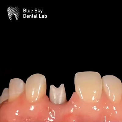 Implante dentário hipoalergênico