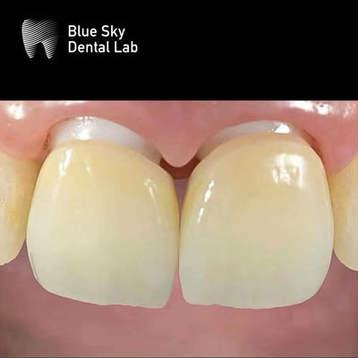 Implante de zircônio em camadas Coroa de zircônio Abutment Biocompativel