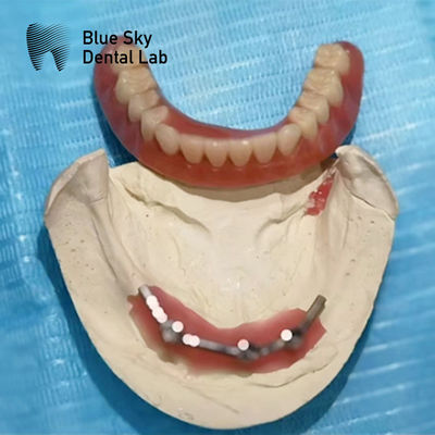 Implante de titânio de barra azul para implantes dentários