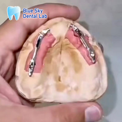 Implante Dental Removível de Barras de Titânio Segmentação Implante Céu Azul
