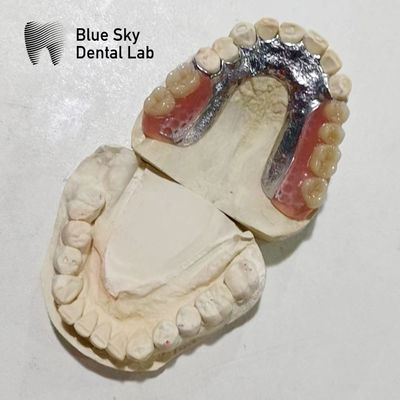 Quadro de Dentes de Resina Rpd Quadro de Metal