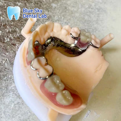 Dentadura parcial de resina acrílica leve com estrutura de metal