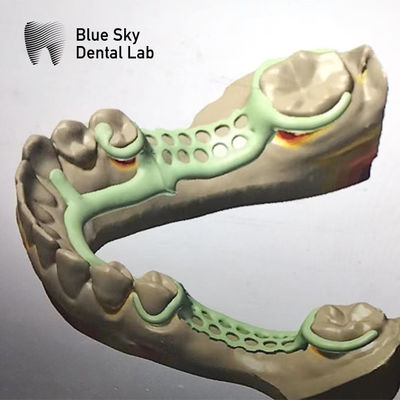 Quadro de metal removível de dentadura parcial