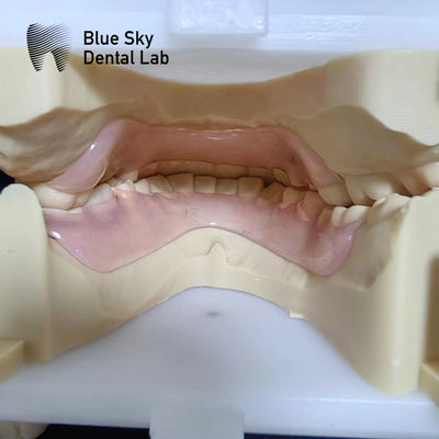 Dentes parciais flexíveis de resina Valplast antes e depois Dentes parciais Valplast