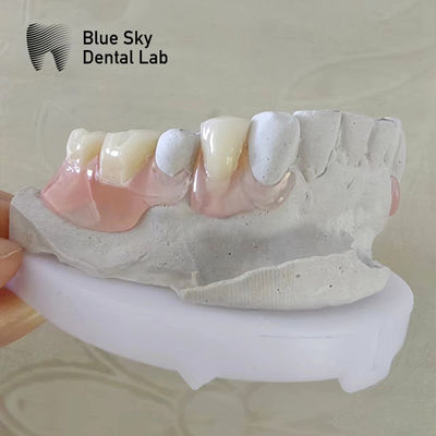 Sorriso Natural Dentário Valplast Dentes Dentárias Flexíveis Valplast Dentes Parciais Removíveis