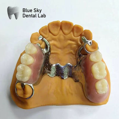 Dental Cast Parcial Dentura Quadro Denturas Parciais que parecem reais