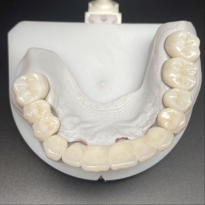 Ponte de zircônio em camadas para restauração fixa Sorrisos bonitos Profissional estável