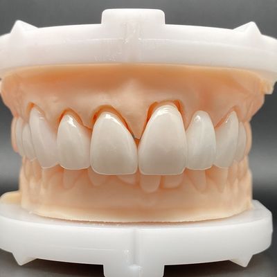 EMax Veneer Cases Passive Fitting em múltiplas cores FAZER um sorriso bonito com o mínimo de preparação do dente
